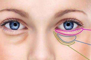 眼袋的不同成因与祛除手术
