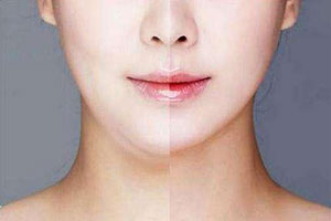 面部吸脂手术有哪些优势？
