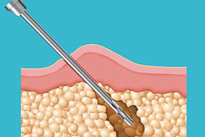 局部吸脂术，瘦你想瘦的地方！