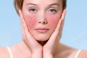 红血丝如何避免皮肤过敏？ 